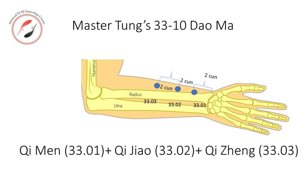 Master Tung acupuncture 33.01 + 33.02 +33.03