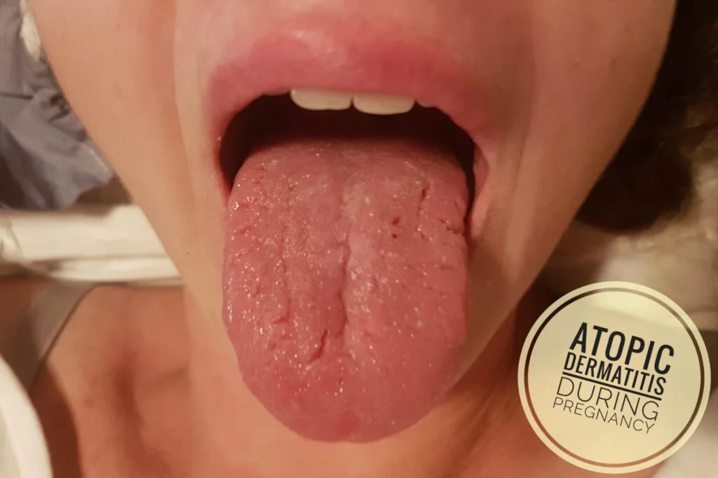 דיקור סיני בהריון אטופיק דרמטיטיס