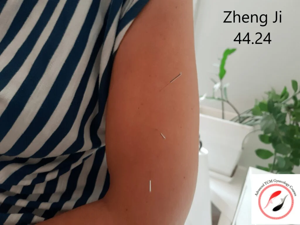 Zheng Ji 44.24 正脊 – Master Tung’s Acupuncture Point