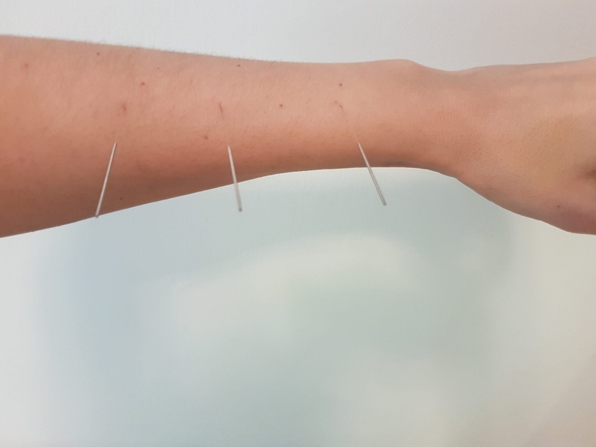 ארכיון Tung's acupuncture סינימד רפואה סינית דיקור סיני לנשים