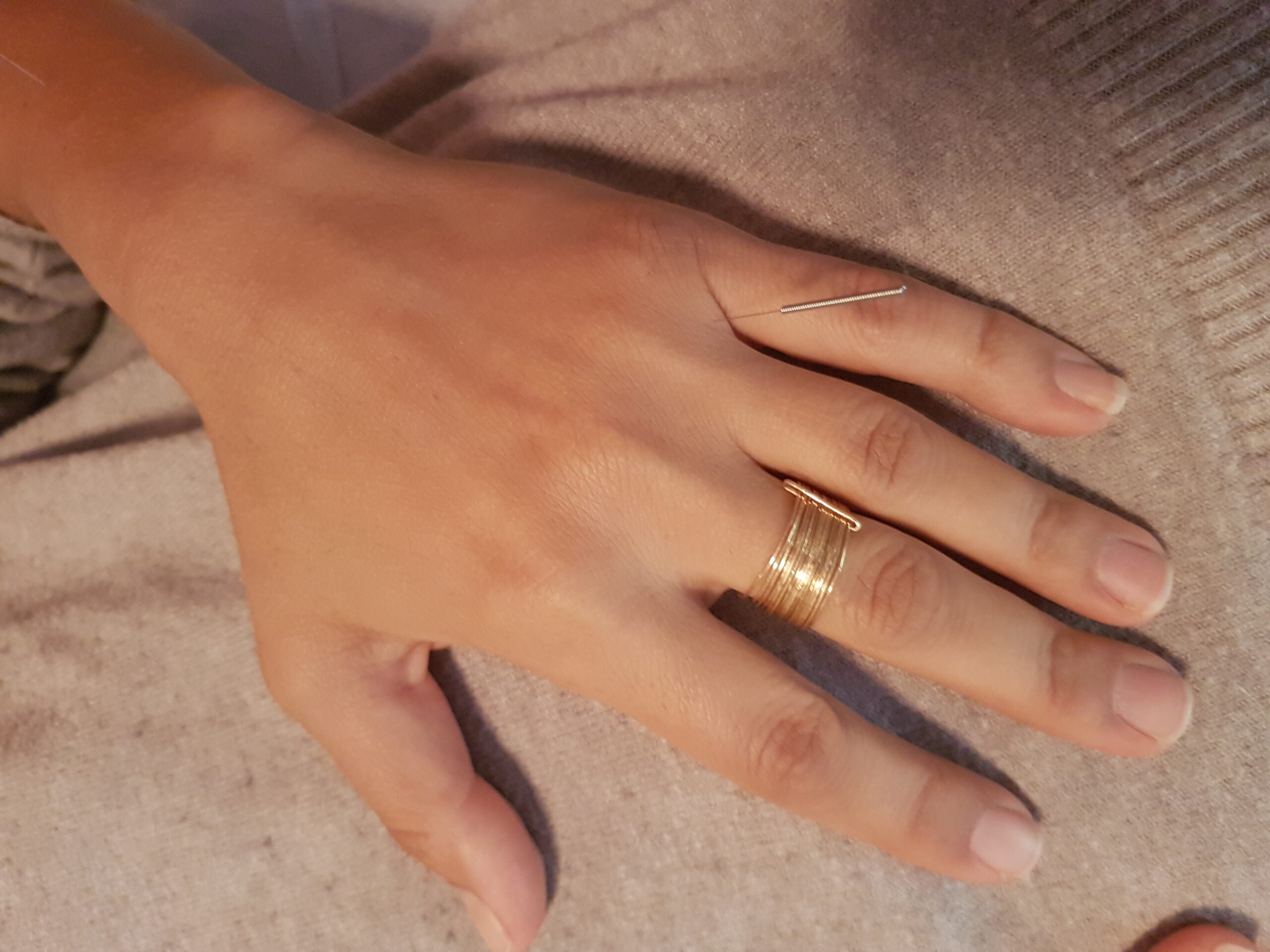 San Cha San 22.17 三叉三 Master Tung’s Acupuncture Point סינימד רפואה