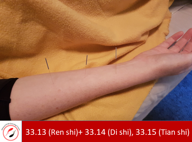 Tung’s Acupuncture points 33.13 (Ren shi), 33.14 (Di shi), 33.15 (Tian shi)