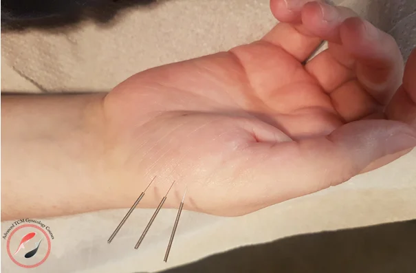 Master Tung’s Acupuncture 22.11 Tu shui  【土水】