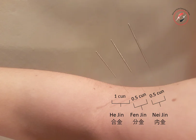 Dr. Hu Wenzhi Three Metal Acupuncture Points- San Jin Xue 【三金穴