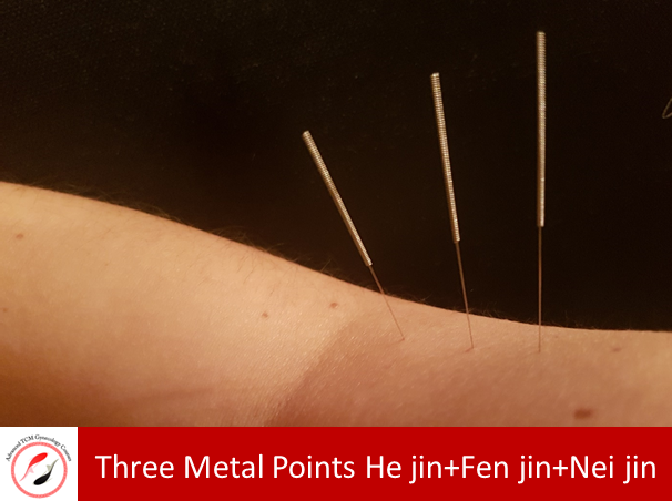 Dr. Hu Wenzhi Three Metal Acupuncture Points- San Jin Xue 【三金穴】