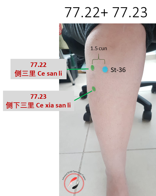 Acupuncture for Calf Trigger Points — Morningside Acupuncture NYC